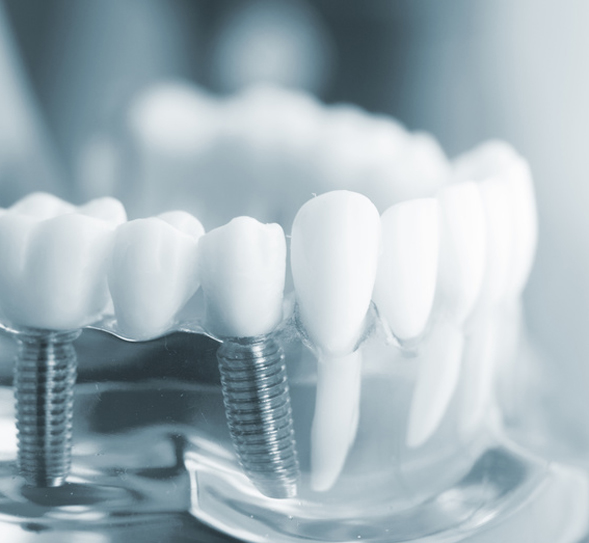 Zahnarztpraxis Javadifar Uetersen - Implantate